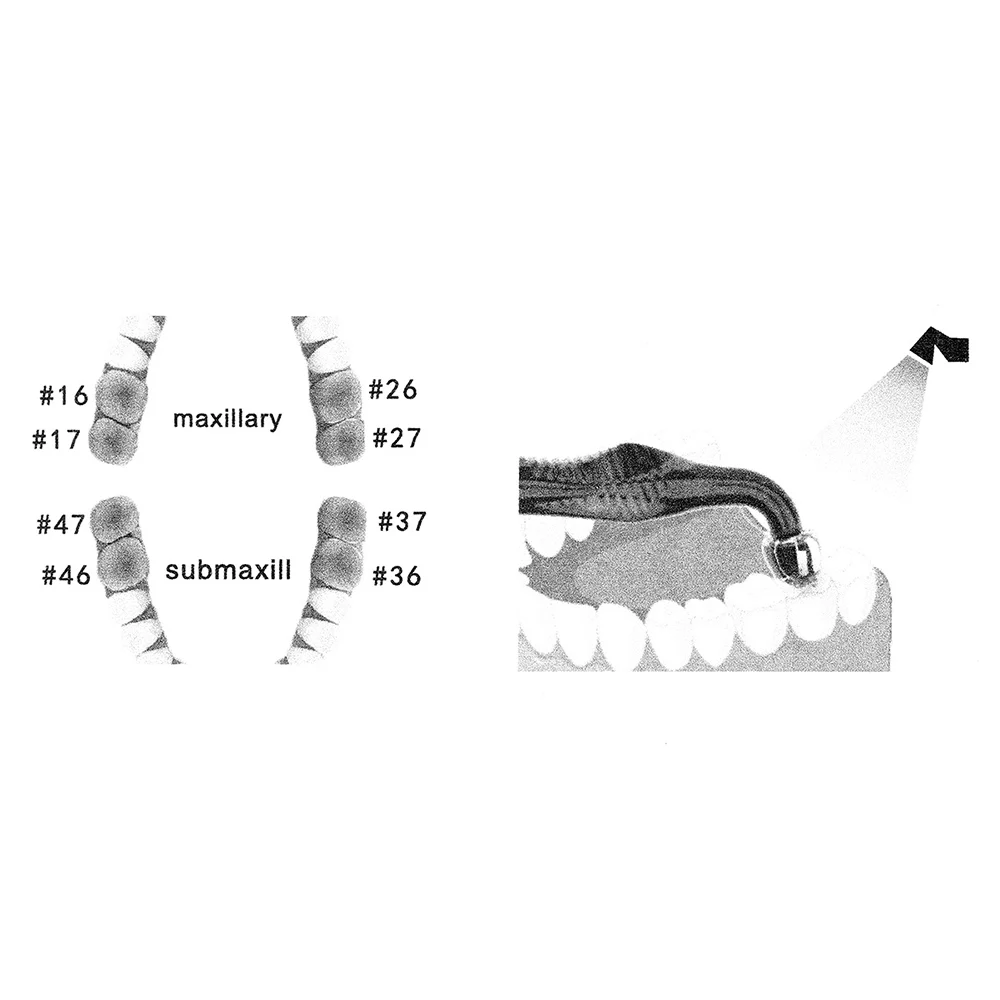 Dental Orthodontic Posterior T - 3D Printing Orthodontics บทวิจารณ์และราคา